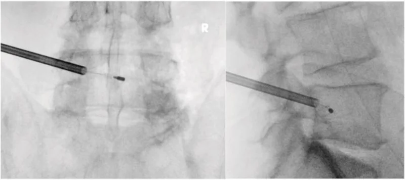 Two X-ray images of the lower spine, front view and side view, showing a cannula entering a vertebra through the pedicle with a small probe tip in the back-middle of the vertebral body.