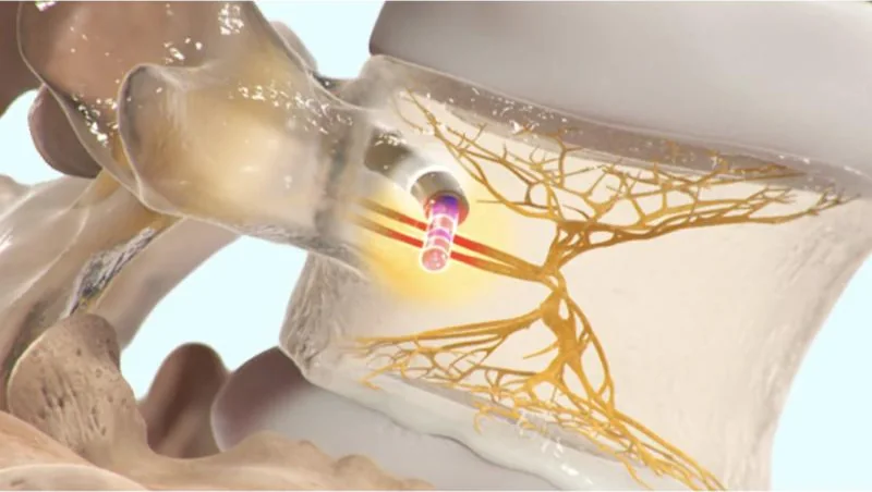 Illustration of a lumbar vertebra with a nerve network drawn in gold inside the bone and a radiofrequency probe inserted through the pedicle, glowing at its tip near the nerve trunk.