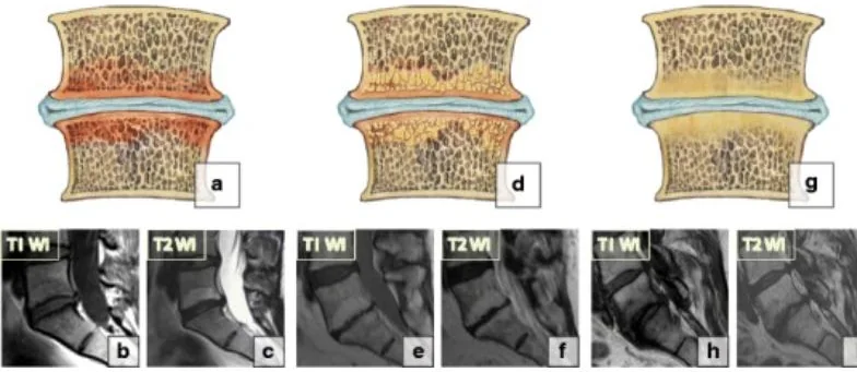 Three drawings of a disc between two vertebrae with the bone next to the disc colored differently in each, above six MRI images labeled T1 and T2.