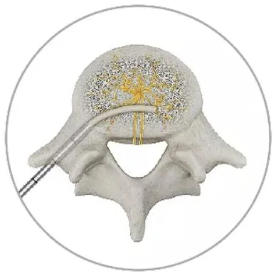 Illustration of a vertebra seen from above with a curved instrument entering through the pedicle and curving toward the center, where gold nerve branches meet.