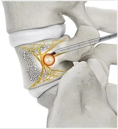 Illustration of a vertebra from the side with gold nerve branches and a glowing orange sphere at the probe tip representing the ablation zone.
