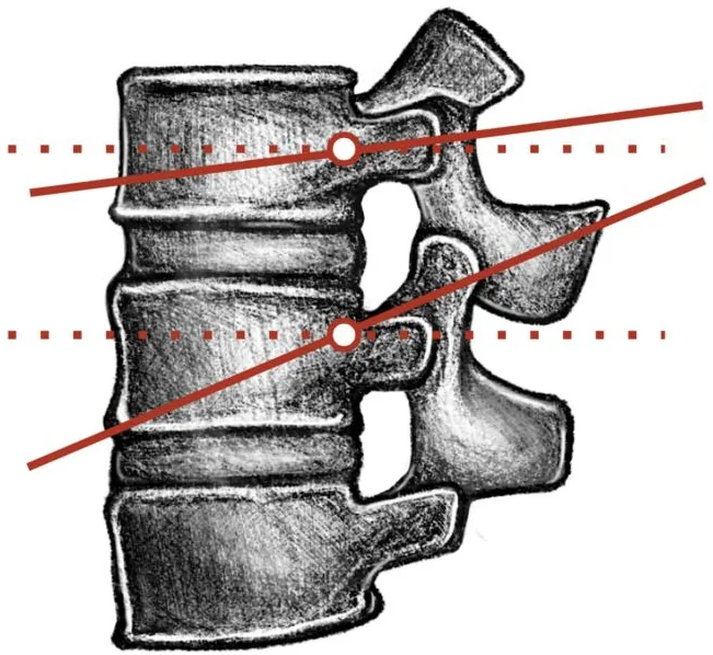 Drawing of two lumbar vertebrae from the side with red lines showing needle paths entering through the pedicle and ending in the back half of the vertebral body.