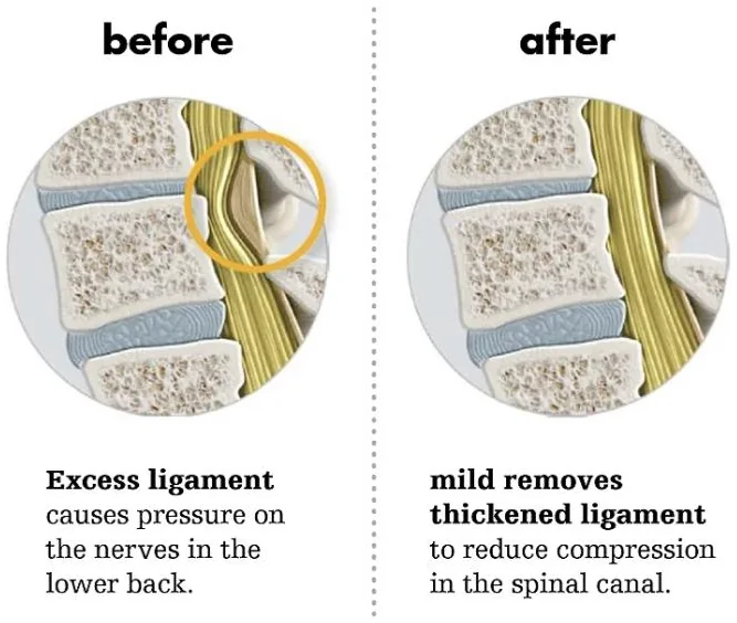 Two circular close-up illustrations of the lower spine from the side. Before: a thickened ligament at the back of the spinal canal bulges into the yellow nerves. After: the ligament is thinner and the nerves have more room.