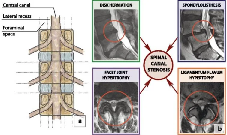 Diagram of the spinal canal seen from behind, beside four MRI images labeled disk herniation, spondylolisthesis, facet joint hypertrophy and ligamentum flavum hypertrophy.