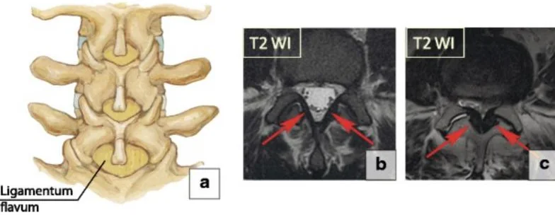 Drawing of the lumbar spine from behind with the ligamentum flavum labeled, beside two cross-section MRI images with red arrows on thickened ligaments.