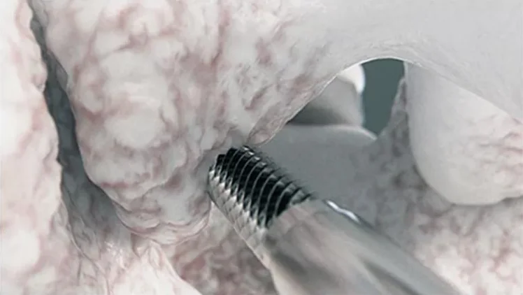 Close-up of a ridged tool against the bony lamina.