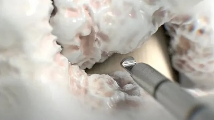 A small tool entering the thickened ligament through the opening in the bone.