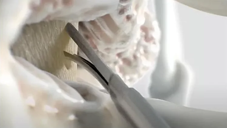 A curved grasping tool working inside the space behind the spinal sac.