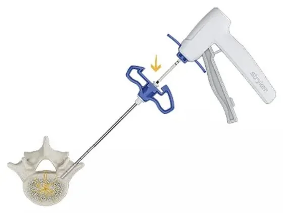 An introducer with a pistol-grip handle being driven through the pedicle into a vertebra.