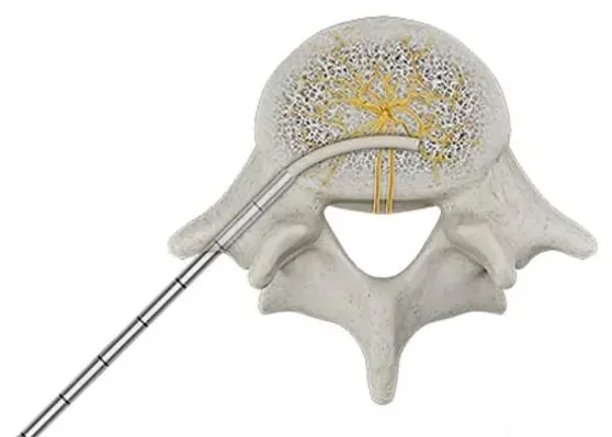 Top-down view of a vertebra with a curved probe reaching the center, where yellow nerve branches spread.