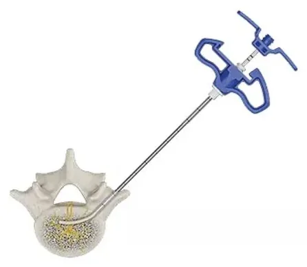 The curved probe locked in place inside the vertebra, with its blue handle outside.