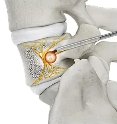 Side view of a vertebra with a glowing sphere of heat at the probe tip among yellow nerve branches.