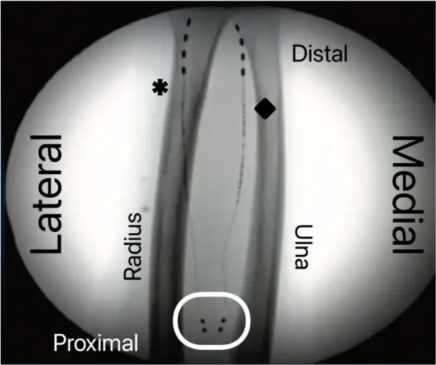 X-ray of a forearm showing two permanently implanted peripheral nerve stimulation leads, each with four contacts, lying beside the radius and ulna.