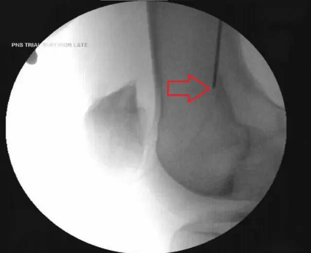 Fluoroscopy X-ray of a knee during placement of a lead at the superior lateral genicular nerve; the arrow marks the lead beside the femur.