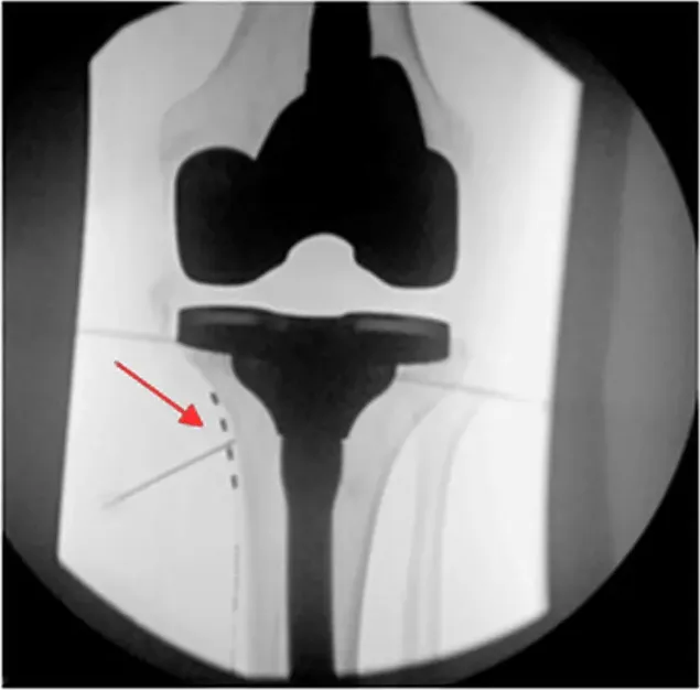 X-ray of a knee with a total knee replacement; the arrow marks a permanent peripheral nerve stimulation lead placed beside the shin bone for the infrapatellar branch of the saphenous nerve.