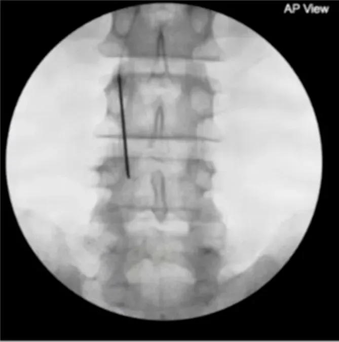 Fluoroscopy X-ray of the lower spine, front view, with a stimulation needle placed at the fourth lumbar vertebra to target the medial branch nerves.