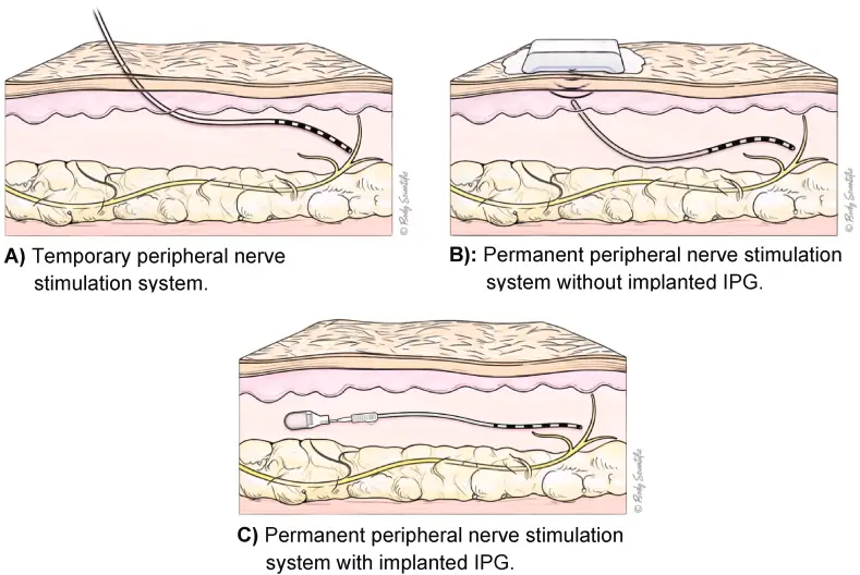 Three cross-section illustrations through skin and fat showing a temporary peripheral nerve stimulation system with a wire exiting the skin, a permanent system with an external device worn on the skin over a shallow implant, and a permanent system with a fully implanted pulse generator