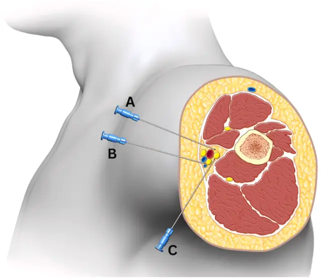 Medical illustration of the upper arm in cross-section showing muscle, bone and the nerve bundle, with three possible needle paths labelled A, B and C approaching the nerves from the skin.