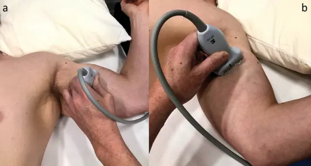 Photograph of a patient lying on a bed with the arm out to the side while a physician holds an ultrasound probe on the upper arm before lead placement.