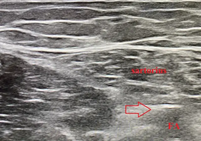 Ultrasound image of the inner thigh during lead placement near the saphenous nerve: the sartorius muscle is labelled and the arrow points to the lead.