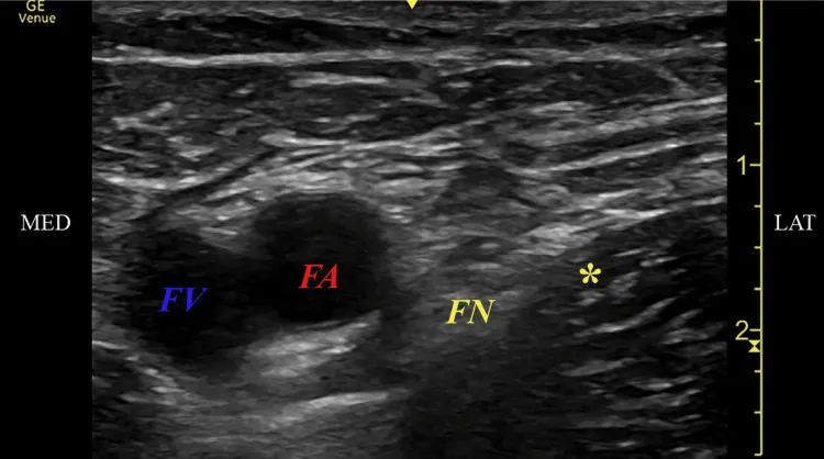Ultrasound image at the groin during a 60-day peripheral nerve stimulation lead placement: the femoral nerve (FN) beside the femoral artery (FA) and vein (FV); the asterisk marks where the lead came to rest.