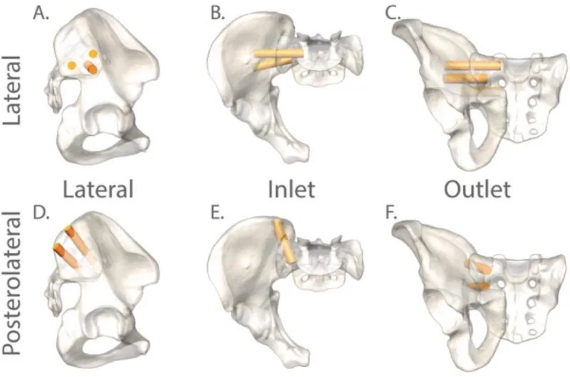 Pelvis models in lateral, inlet and outlet views comparing lateral implants that cross the joint from the side with posterolateral implants entering from behind at an angle.