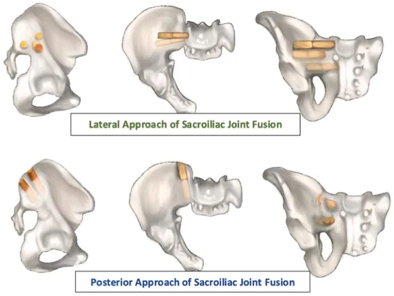 Three views of a pelvis. Top row: implants entering from the side of the pelvis and crossing the sacroiliac joint. Bottom row: implants placed from behind into the back of the joint.
