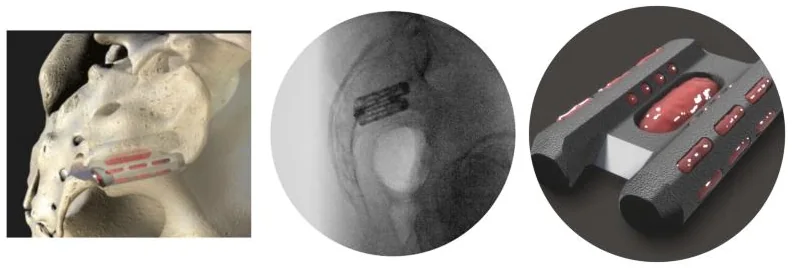 Three images: an illustration of an implant crossing the lower sacroiliac joint from behind and below, a side-view X-ray of the same implant, and a close-up of the twin-pontoon titanium implant.