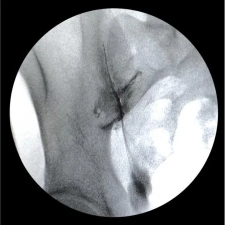 Circular X-ray of the low back and pelvis with a thin dark line of contrast dye tracing the SI joint.