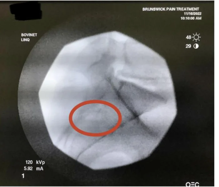 Photograph of an X-ray monitor showing the sacroiliac joint with a red circle marking the faint outline of a bone-graft implant.