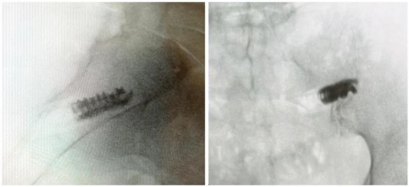 Two X-ray images showing a small threaded titanium implant seated in the back of the sacroiliac joint.