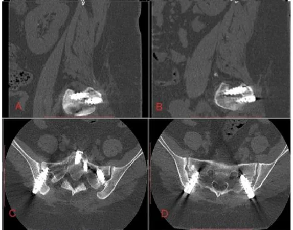 Four CT scan slices of the pelvis: two side views and two cross-sections, each showing bright threaded screws crossing the sacroiliac joint.
