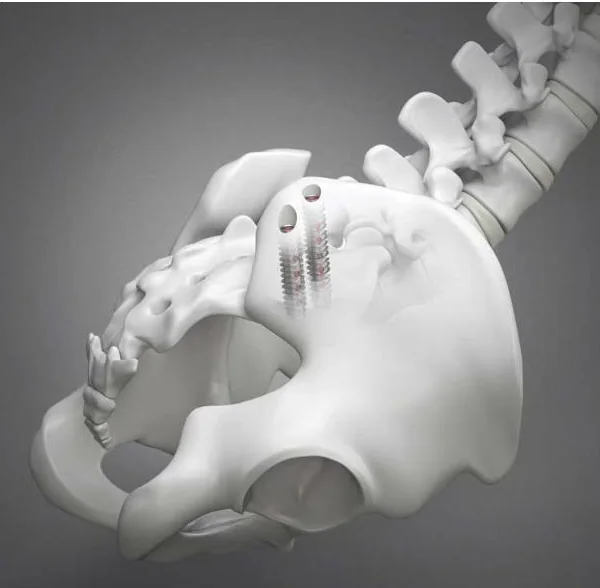 Illustration of a pelvis seen from behind with two threaded implants entering the back of the pelvis and crossing into the sacrum.