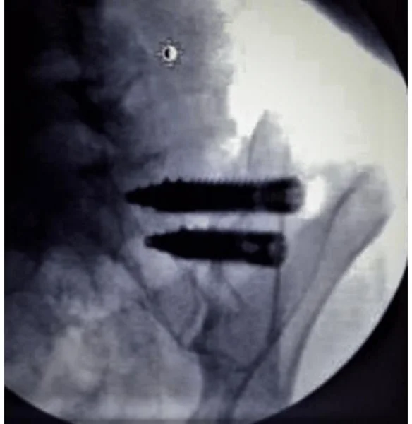 Side-view X-ray of the pelvis showing two large threaded screws crossing the sacroiliac joint from behind.