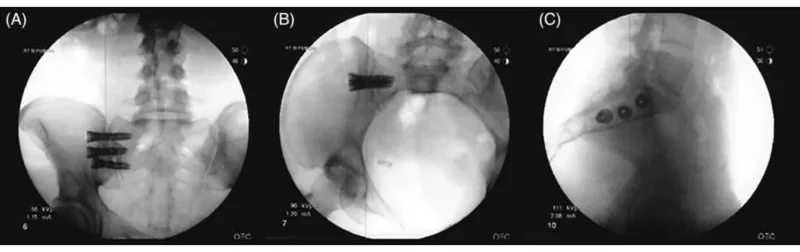 Three live X-ray images of the pelvis showing three threaded implants crossing the sacroiliac joint from the side.