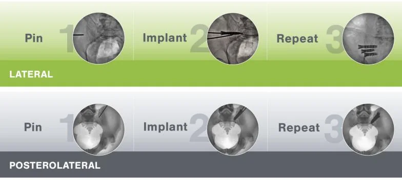 Manufacturer diagram with two rows of three X-ray thumbnails labeled pin, implant, repeat: the top row for the lateral path, the bottom row for the posterolateral path.