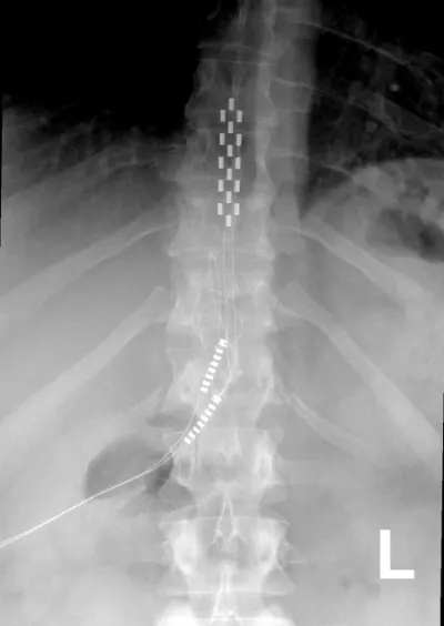 Front-view X-ray of the thoracic spine showing an implanted paddle lead and a percutaneous lead in the posterior epidural space.